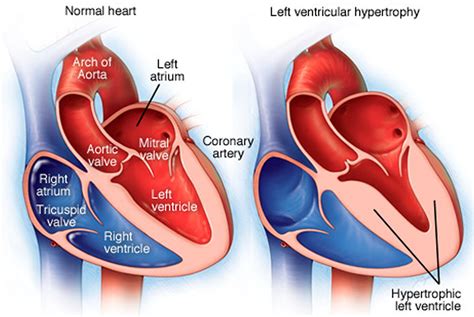 normal left ventricular enlargement